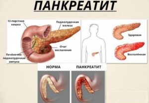 Признаки болезни поджелудочной железы - панкреатит