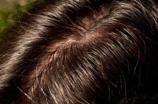 Почему волосы быстро жирнеют: 10 распространённых причин